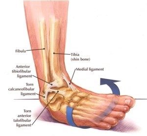 chronic ankle instability