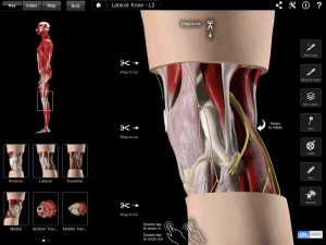 ITB Friction Syndrome 