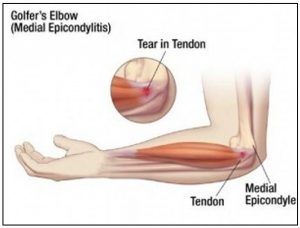 Medial Epicondylalgia
