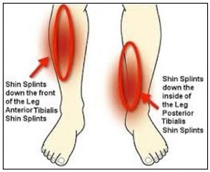 Medial Tibial Stress Syndrome