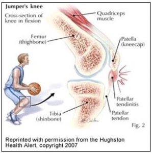 Patellar Tendinopathy 