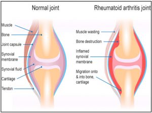 Rheumatoid Arthritis