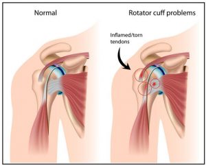 Rotator Cuff