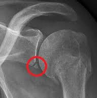 Shoulder Dislocation