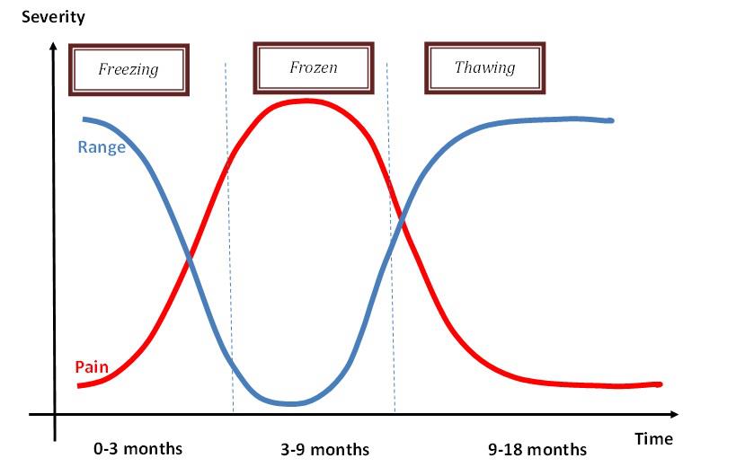 A Review of Current Frozen Shoulder Treatment Options with Lewis Craig