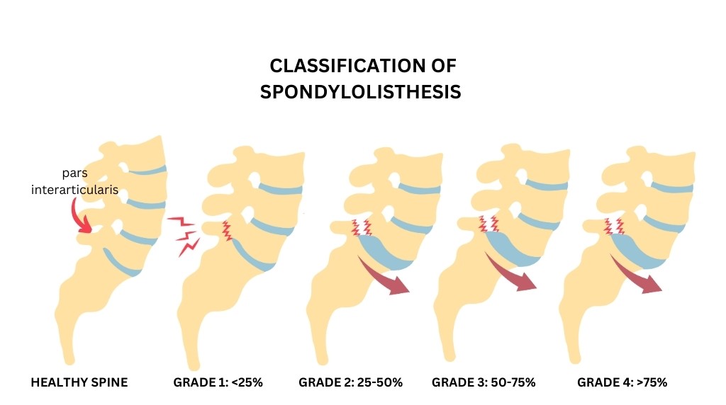 Lower Back Pain