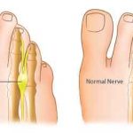 neuroma