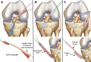 recovery time for acl tear