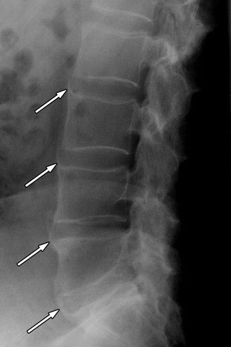 Ankylosing Spondylitis