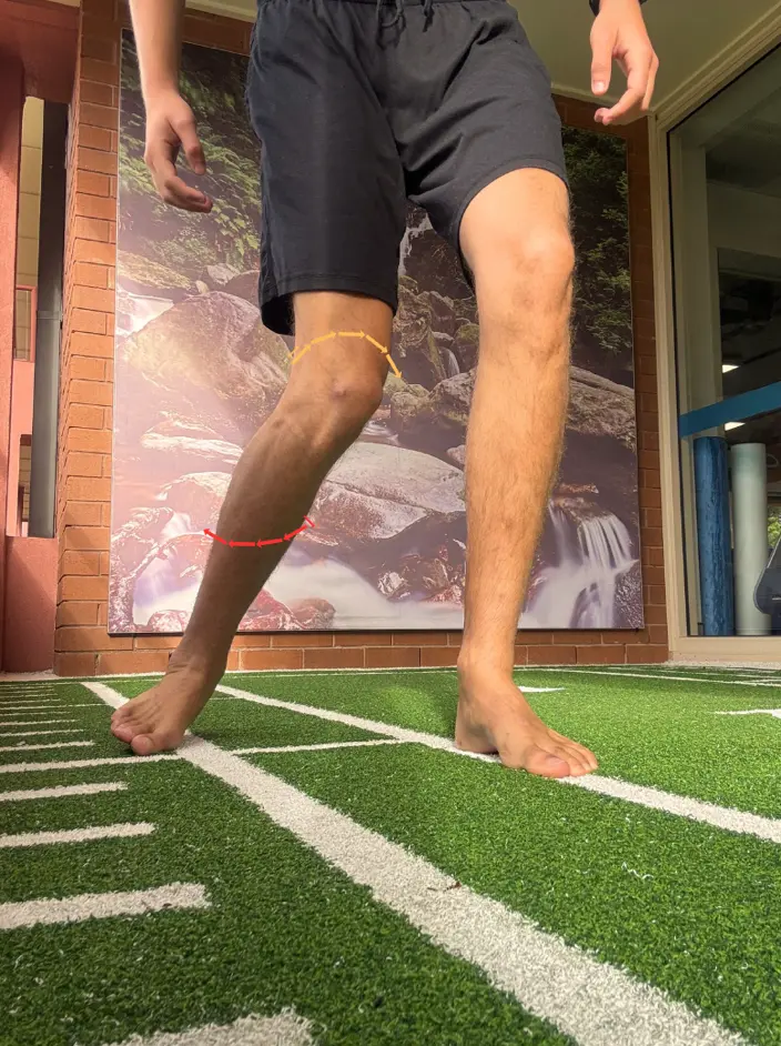the common mechanism of injury for the ACL