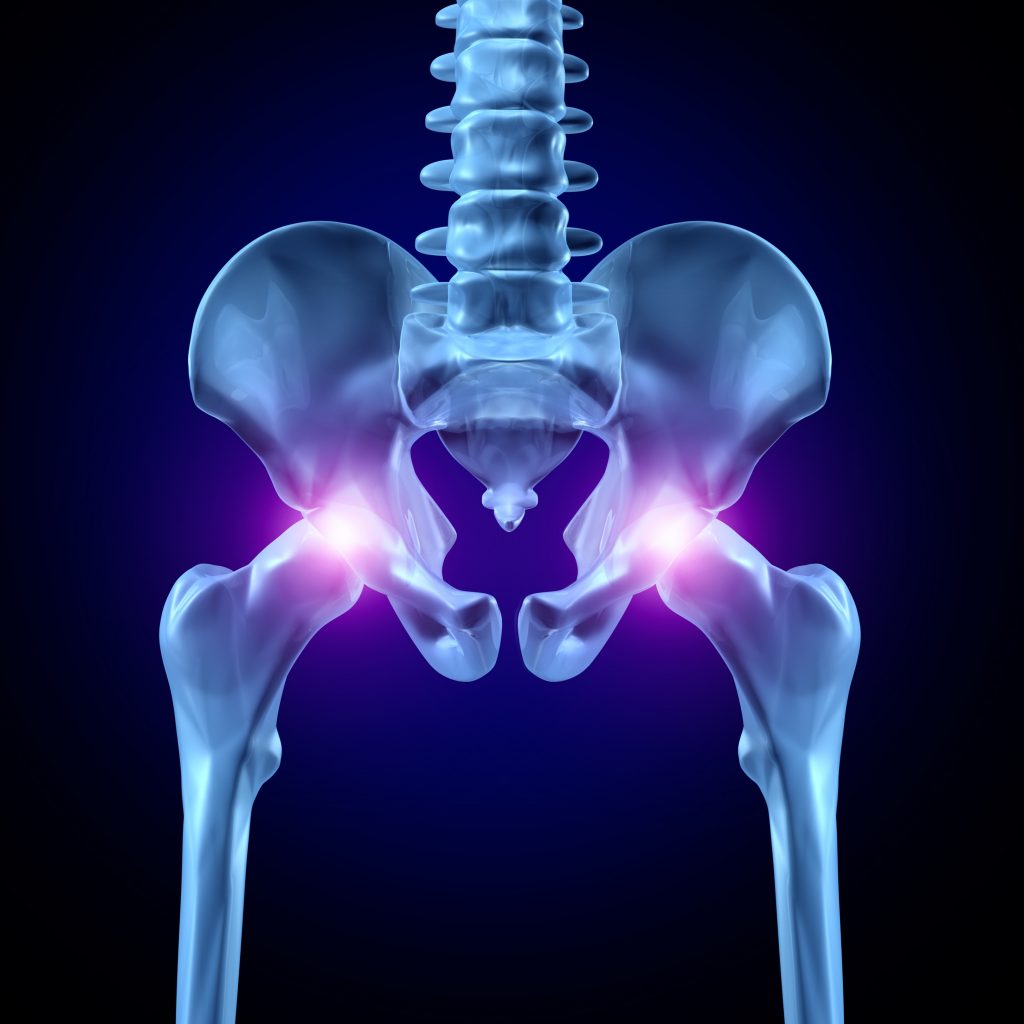 impingement