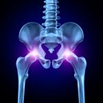 impingement