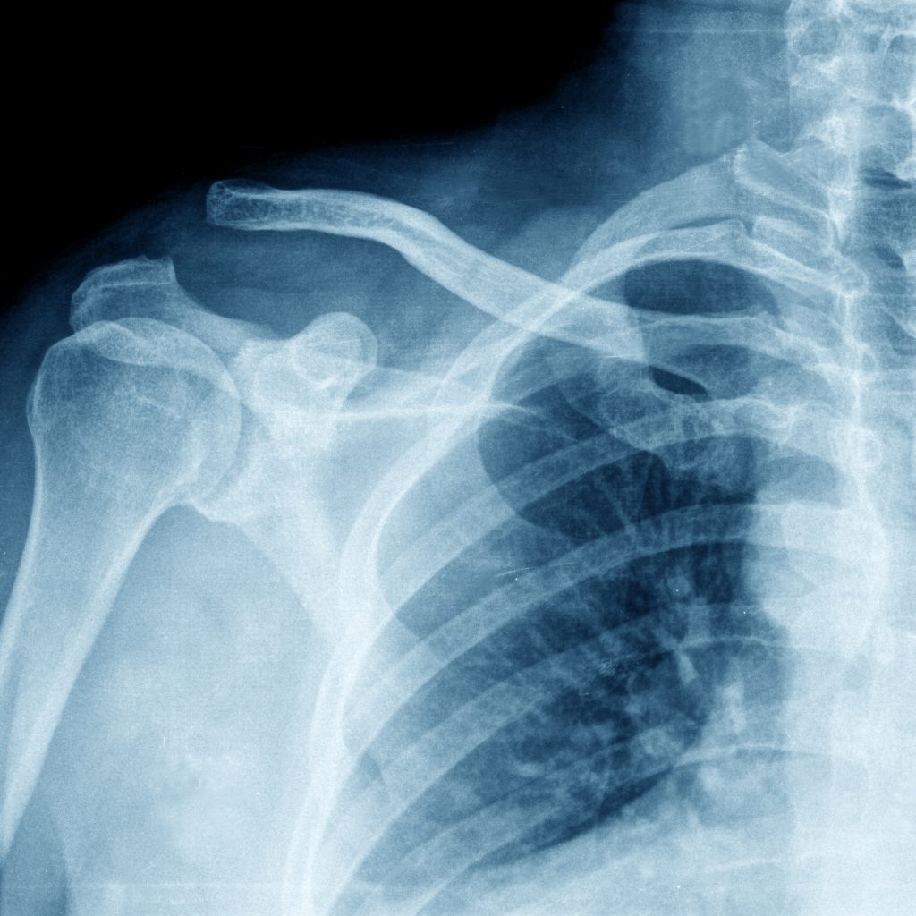shoulder