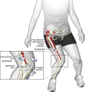 Ruptured ACL