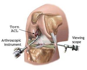 Ruptured ACL