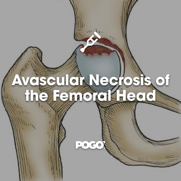 Avascular Necrosis Of The Femoral Head Laptrinhx News