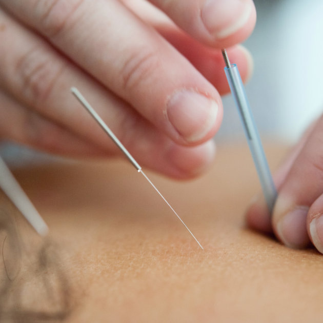 physio dry needling near me