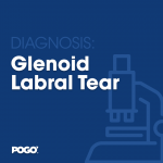Glenoid labral tear