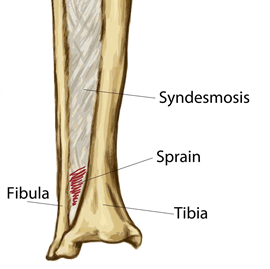 Ankle Syndesmosis Injuries