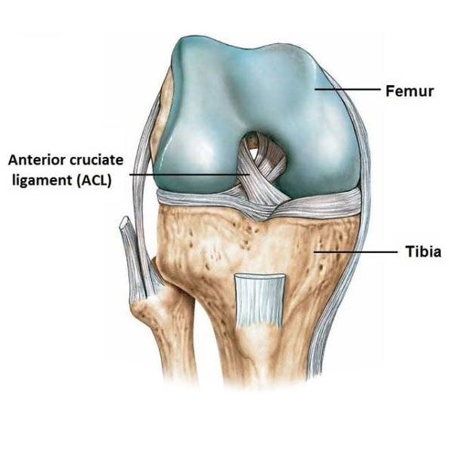 Ruptured ACL