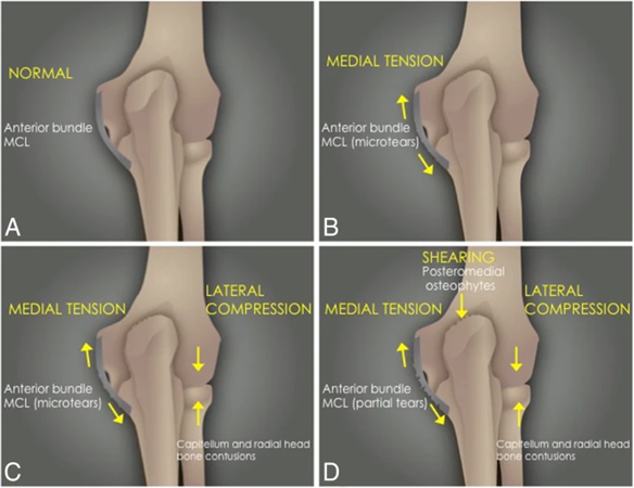 Elbow Pain