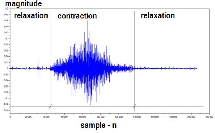 EMG tracing