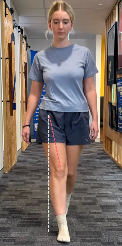 position of adduction (across the midline of hip)