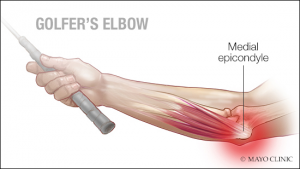 Golfers Elbow