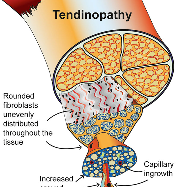 Tendinopathy