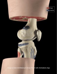 patellofemoral pain