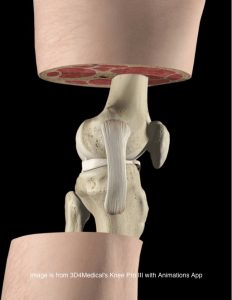 patellofemoral pain