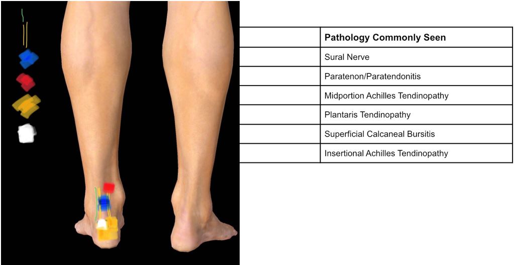 Insertional Achilles Tendinopathy POGO Physio Gold Coast