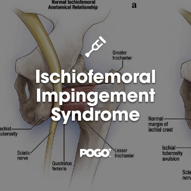 What is Ischial Bursitis? - Brisbane Physiotherapy