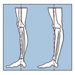 knee pain