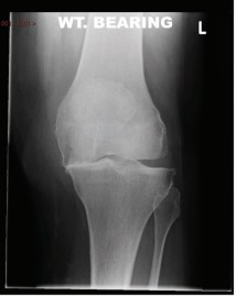 Knee Osteoarthritis