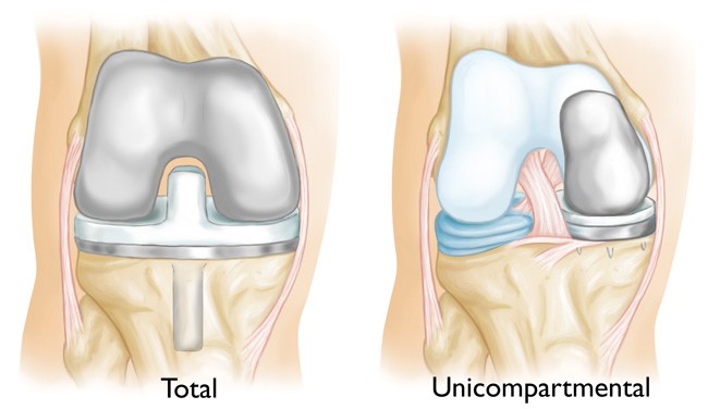 Knee Osteoarthritis