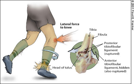 Ankle Syndesmosis Injuries
