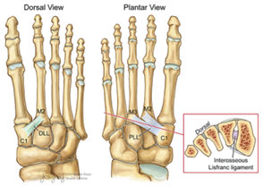 Lisfranc Injury 