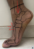 Lisfranc Injury 