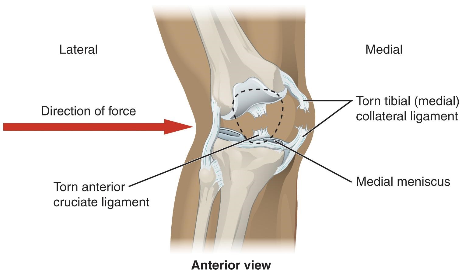 MCL Sprains