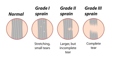 MCL Sprains