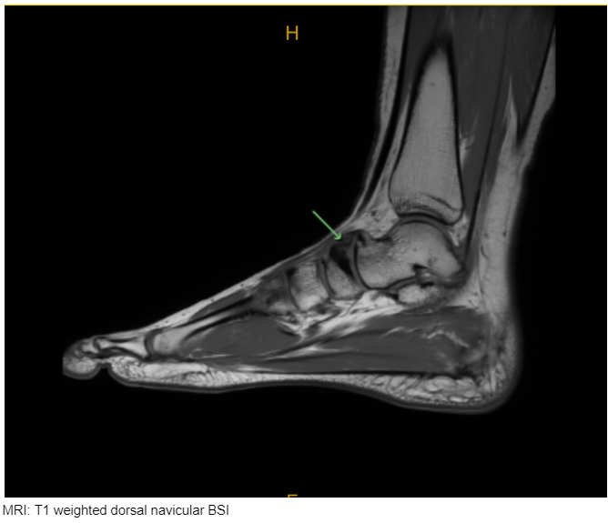 Navicular bone stress