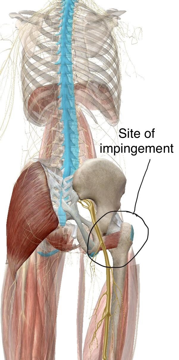 Ischiofemoral Impingement Syndrome POGO Physio Gold Coast Ischiofemoral Impingement Syndrome POGO Physio Gold Coast