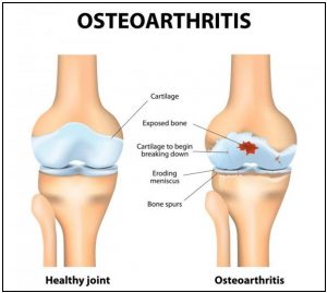I fokú ízületi osteoarthritis)