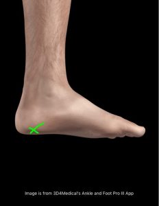 Plantar Fasciitis