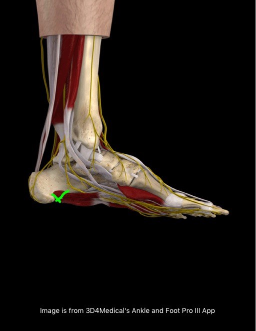 Plantar Fasciitis