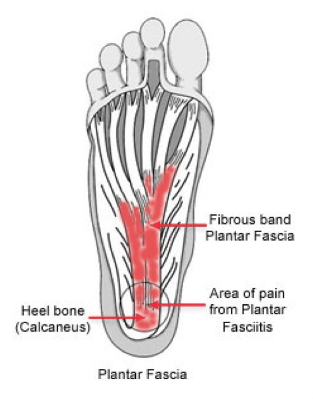 Plantar Fasciitis