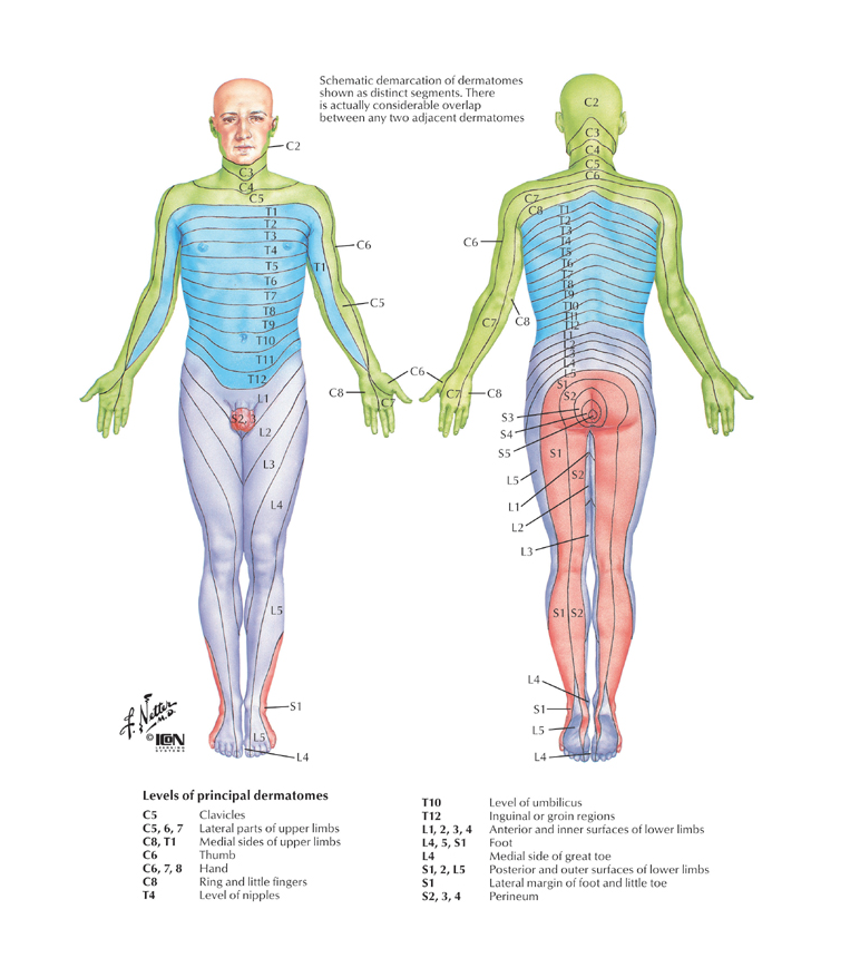 Plantar Fasciitis