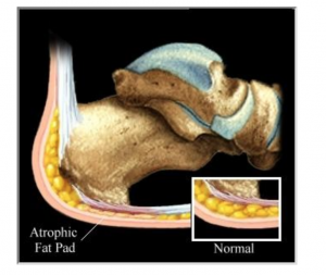 Plantar Fasciitis