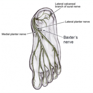 plantar fasciitis